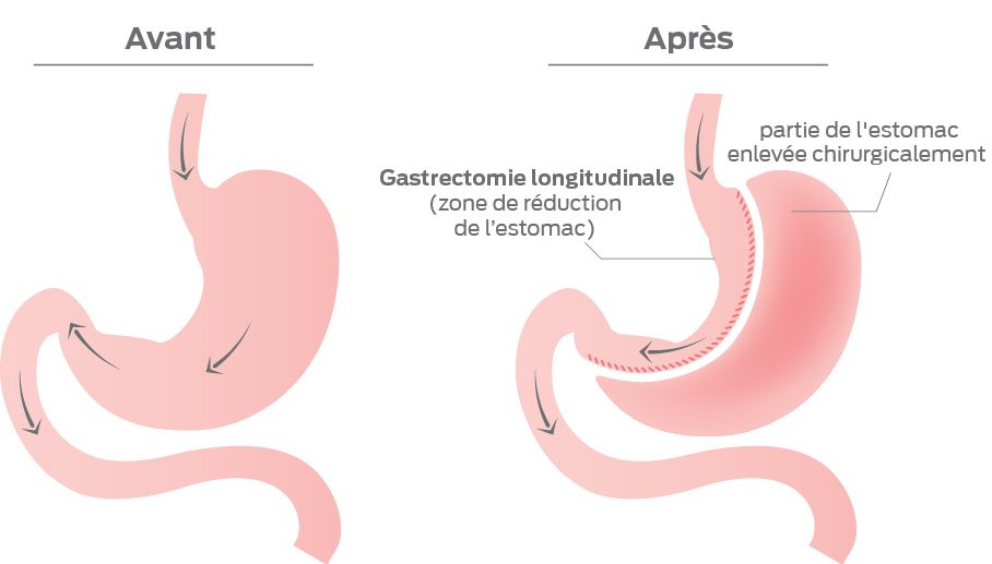 Sleeve gastrectomie en Tunisie - Clinique Sleeve